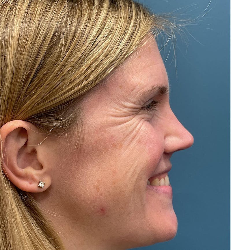 Dermal Fillers & Botox Before & After Gallery - Patient 259208 - Image 3