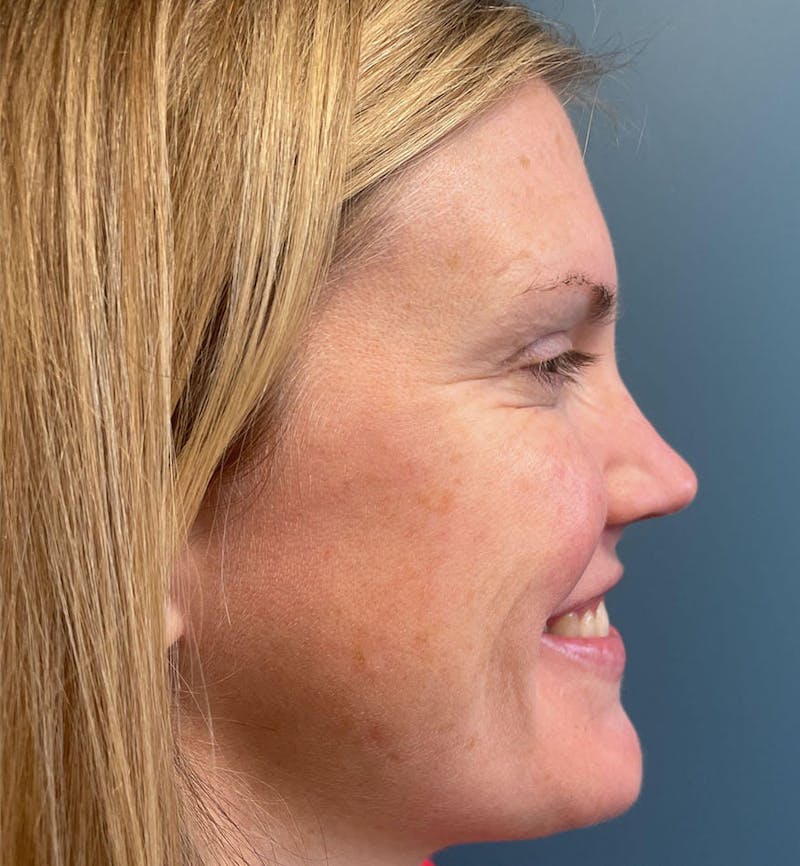Dermal Fillers & Botox Before & After Gallery - Patient 259208 - Image 4