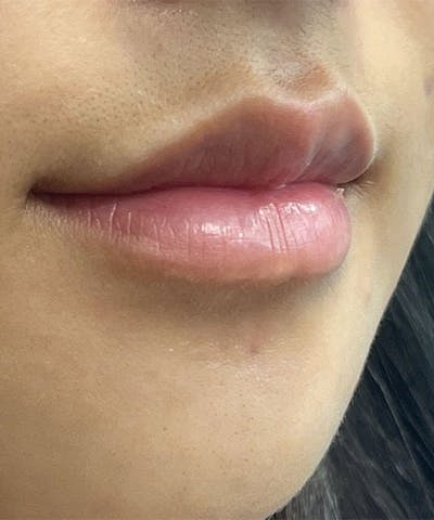 Dermal Fillers & Botox Before & After Gallery - Patient 332457 - Image 1