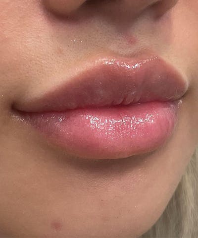 Dermal Fillers & Botox Before & After Gallery - Patient 332457 - Image 2