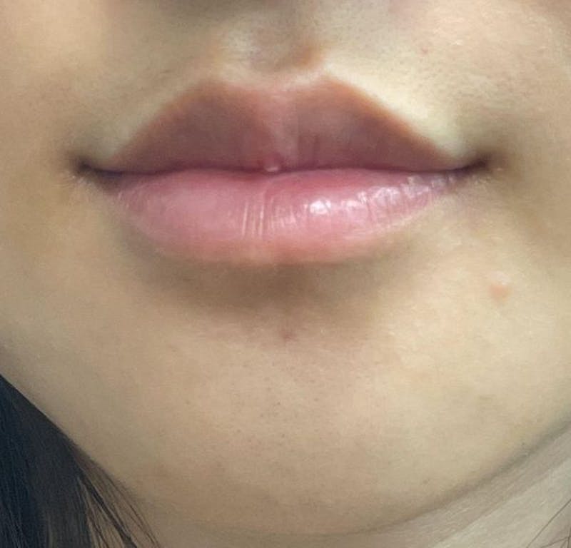 Dermal Fillers & Botox Before & After Gallery - Patient 332457 - Image 3