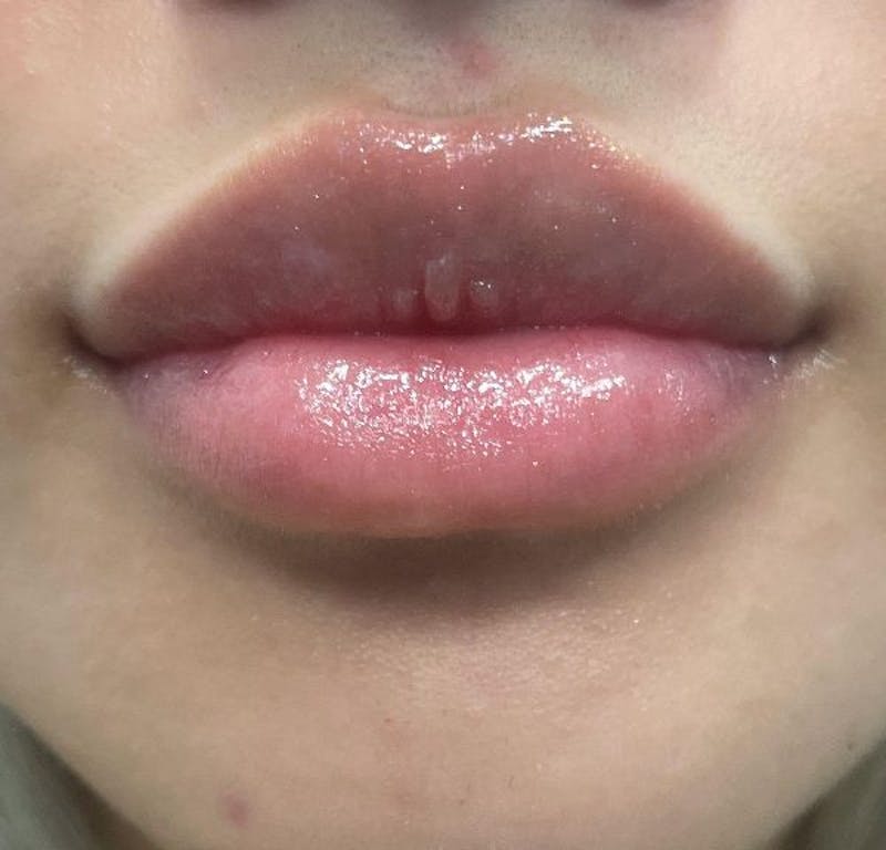Dermal Fillers & Botox Before & After Gallery - Patient 332457 - Image 4