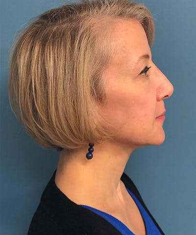 Dermal Fillers & Botox Before & After Gallery - Patient 279526 - Image 2