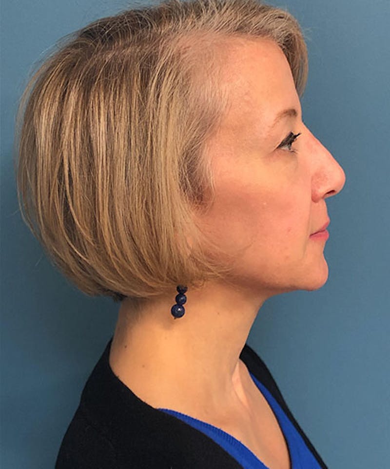Dermal Fillers & Botox Before & After Gallery - Patient 279526 - Image 2