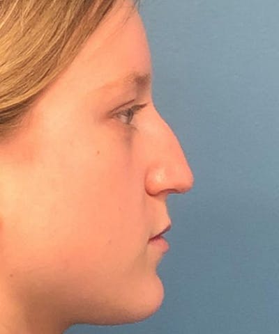 Dermal Fillers & Botox Before & After Gallery - Patient 687835 - Image 1