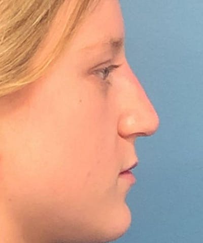 Dermal Fillers & Botox Before & After Gallery - Patient 687835 - Image 2