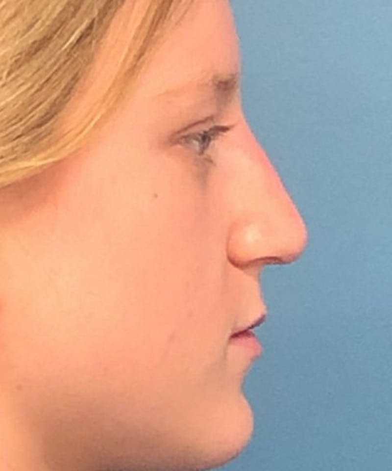 Dermal Fillers & Botox Before & After Gallery - Patient 687835 - Image 2