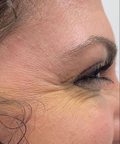 Dermal Fillers & Botox Before & After Gallery - Patient 239347 - Image 1