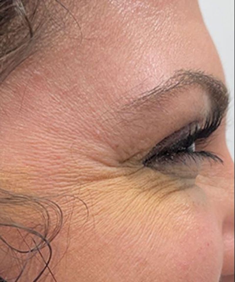 Dermal Fillers & Botox Before & After Gallery - Patient 239347 - Image 1