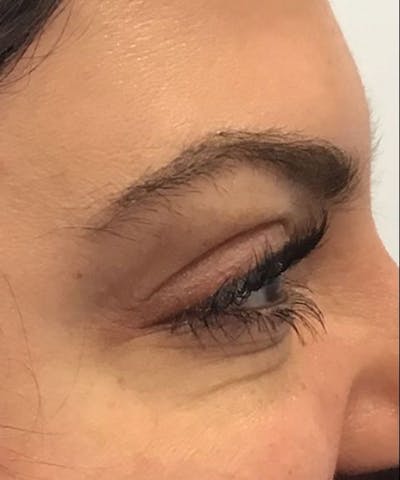Dermal Fillers & Botox Before & After Gallery - Patient 239347 - Image 2