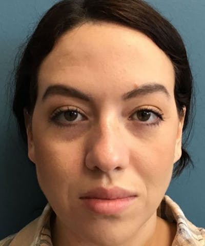Dermal Fillers & Botox Before & After Gallery - Patient 206826 - Image 1