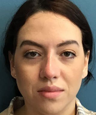 Dermal Fillers & Botox Before & After Gallery - Patient 206826 - Image 2