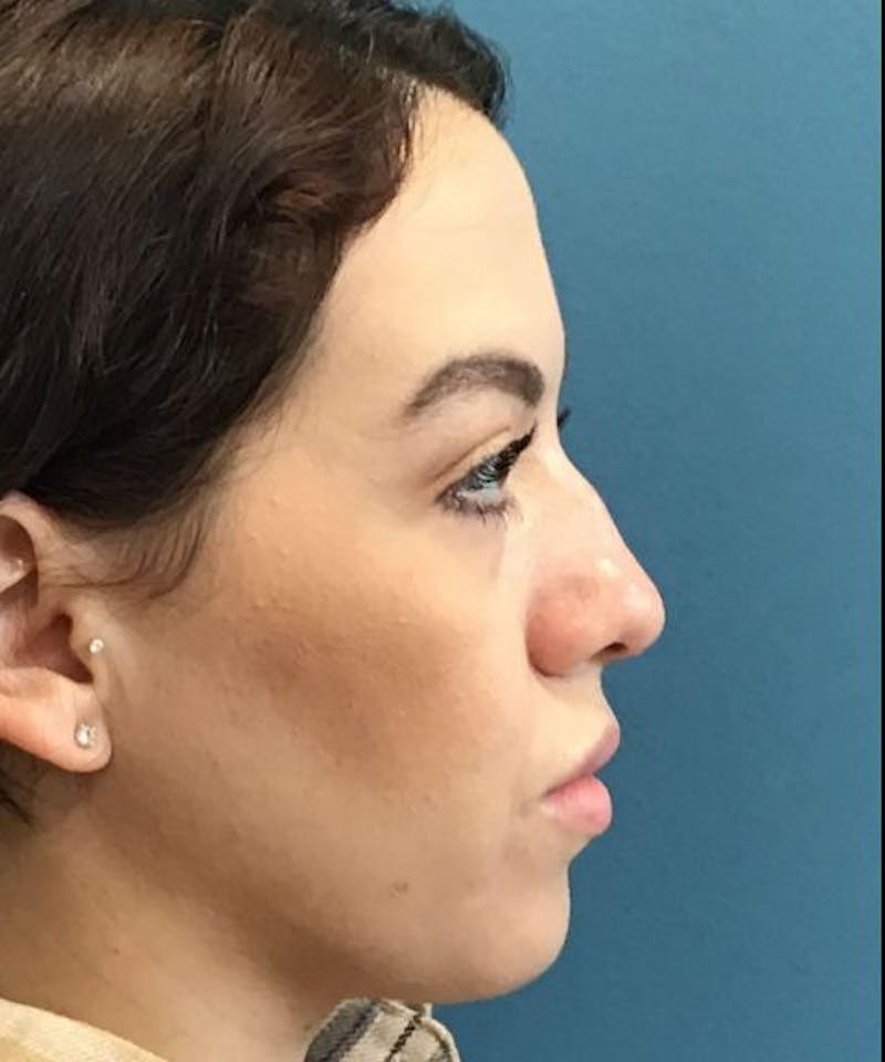 Dermal Fillers & Botox Before & After Gallery - Patient 206826 - Image 3