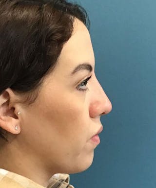 Dermal Fillers & Botox Before & After Gallery - Patient 206826 - Image 4