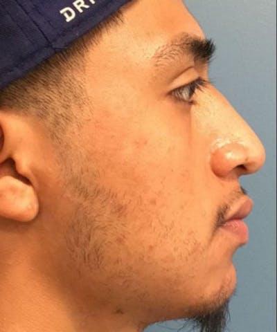 Dermal Fillers & Botox Before & After Gallery - Patient 192323 - Image 1
