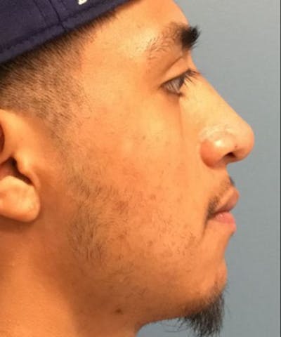 Dermal Fillers & Botox Before & After Gallery - Patient 192323 - Image 2