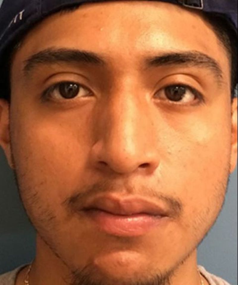 Dermal Fillers & Botox Before & After Gallery - Patient 192323 - Image 3