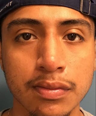 Dermal Fillers & Botox Before & After Gallery - Patient 192323 - Image 4