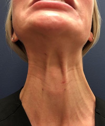 Dermal Fillers & Botox Before & After Gallery - Patient 116397 - Image 1