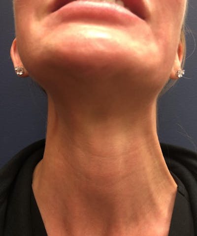 Dermal Fillers & Botox Before & After Gallery - Patient 116397 - Image 2