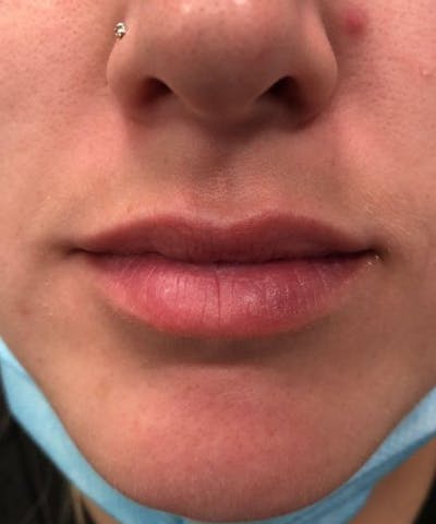 Dermal Fillers & Botox Before & After Gallery - Patient 190232 - Image 1