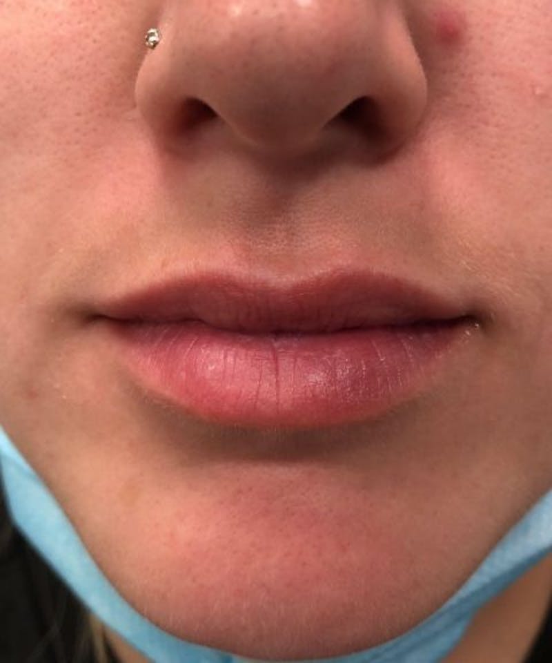 Dermal Fillers & Botox Before & After Gallery - Patient 190232 - Image 1