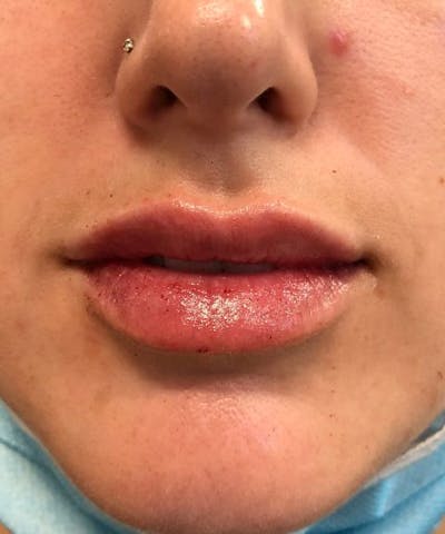 Dermal Fillers & Botox Before & After Gallery - Patient 190232 - Image 2