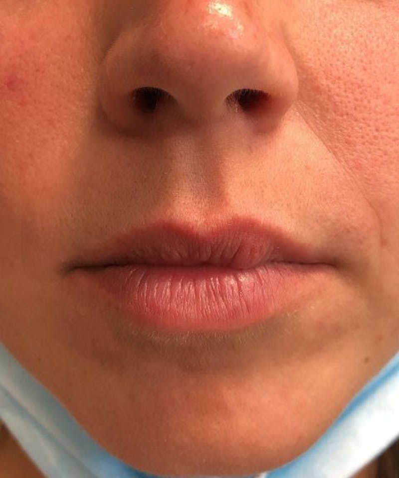 Dermal Fillers & Botox Before & After Gallery - Patient 229936 - Image 1