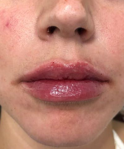 Dermal Fillers & Botox Before & After Gallery - Patient 229936 - Image 2