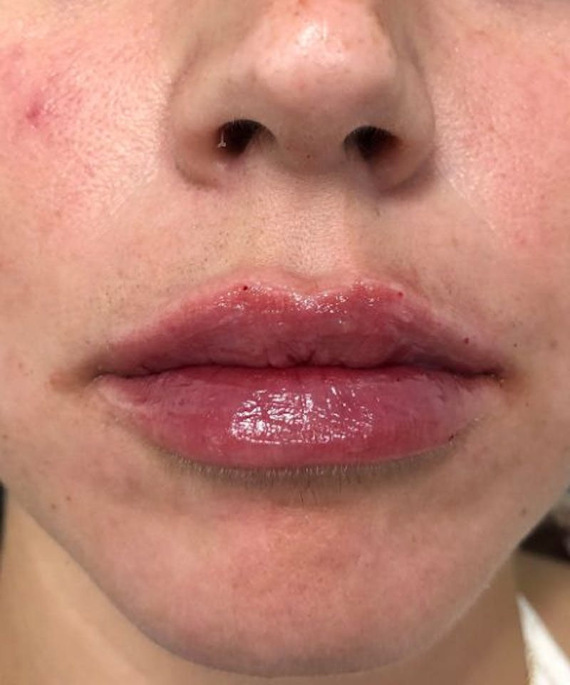 Dermal Fillers & Botox Before & After Gallery - Patient 229936 - Image 2