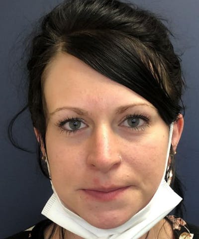 Dermal Fillers & Botox Before & After Gallery - Patient 149691 - Image 1