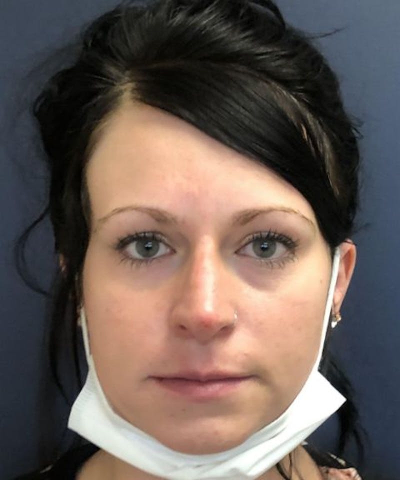Dermal Fillers & Botox Before & After Gallery - Patient 149691 - Image 2