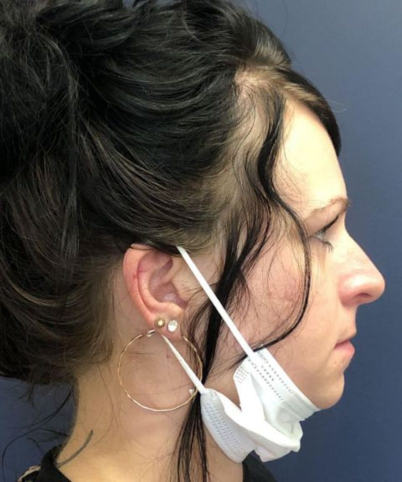 Dermal Fillers & Botox Before & After Gallery - Patient 149691 - Image 3