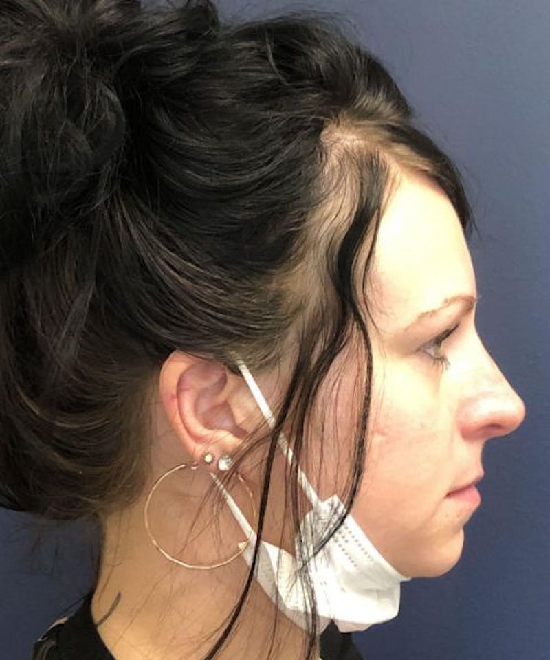 Dermal Fillers & Botox Before & After Gallery - Patient 149691 - Image 4