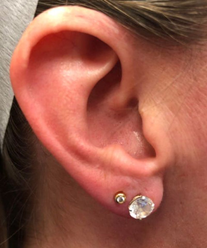 Dermal Fillers & Botox Before & After Gallery - Patient 328577 - Image 2