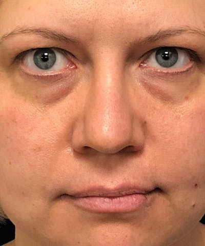 Dermal Fillers & Botox Before & After Gallery - Patient 326800 - Image 1