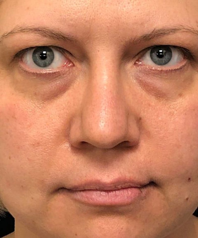 Dermal Fillers & Botox Before & After Gallery - Patient 326800 - Image 1
