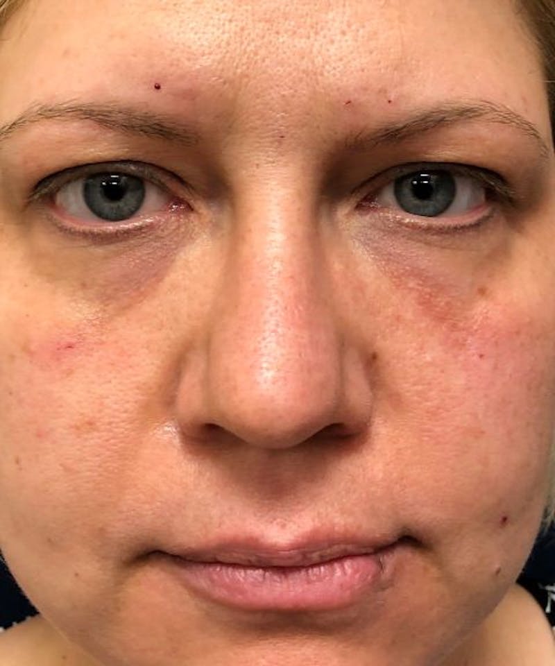 Dermal Fillers & Botox Before & After Gallery - Patient 326800 - Image 2
