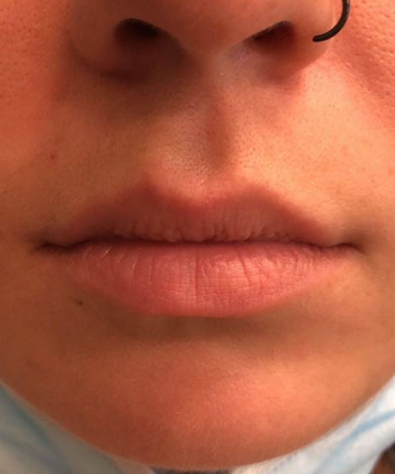 Dermal Fillers & Botox Before & After Gallery - Patient 361572 - Image 1