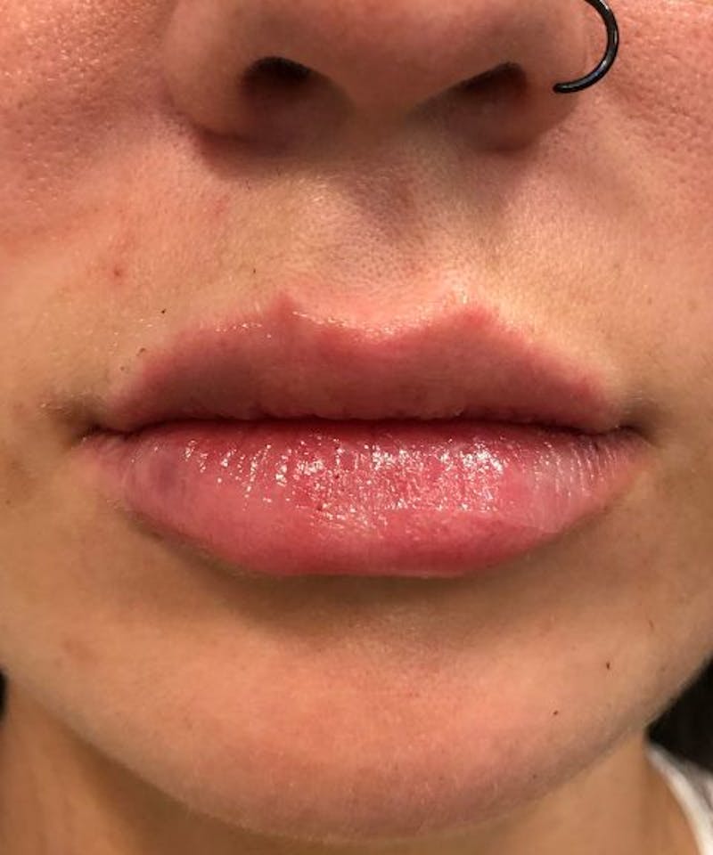 Dermal Fillers & Botox Before & After Gallery - Patient 361572 - Image 2