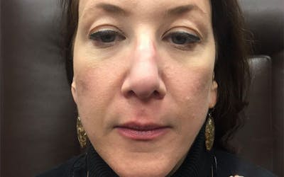Dermal Fillers & Botox Before & After Gallery - Patient 173412 - Image 1