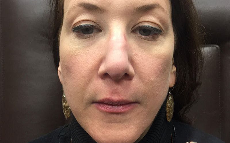 Dermal Fillers & Botox Before & After Gallery - Patient 173412 - Image 1