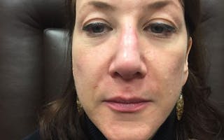 Dermal Fillers & Botox Before & After Gallery - Patient 173412 - Image 2