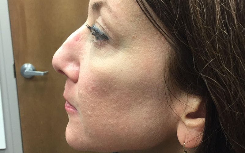 Dermal Fillers & Botox Before & After Gallery - Patient 173412 - Image 3
