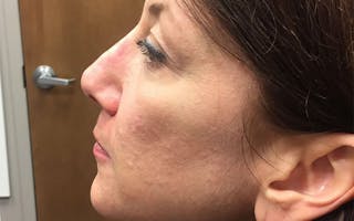 Dermal Fillers & Botox Before & After Gallery - Patient 173412 - Image 4