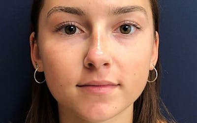 Dermal Fillers & Botox Before & After Gallery - Patient 354038 - Image 1