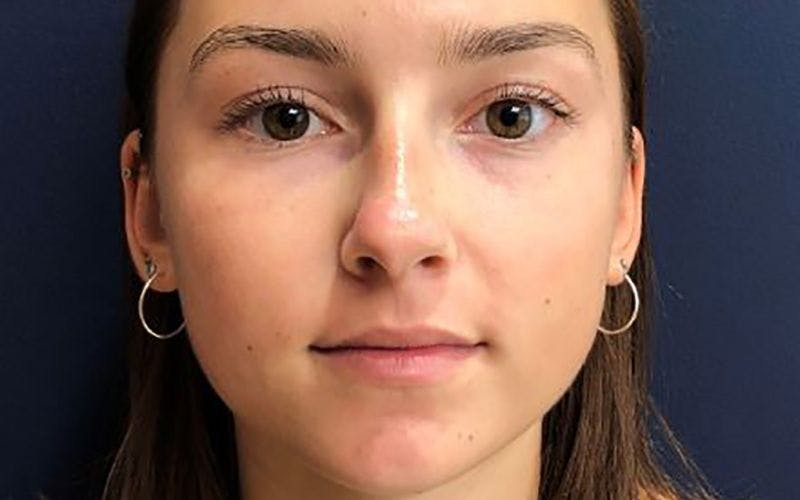 Dermal Fillers & Botox Before & After Gallery - Patient 354038 - Image 1