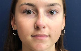 Dermal Fillers & Botox Before & After Gallery - Patient 354038 - Image 2