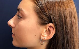 Dermal Fillers & Botox Before & After Gallery - Patient 354038 - Image 4