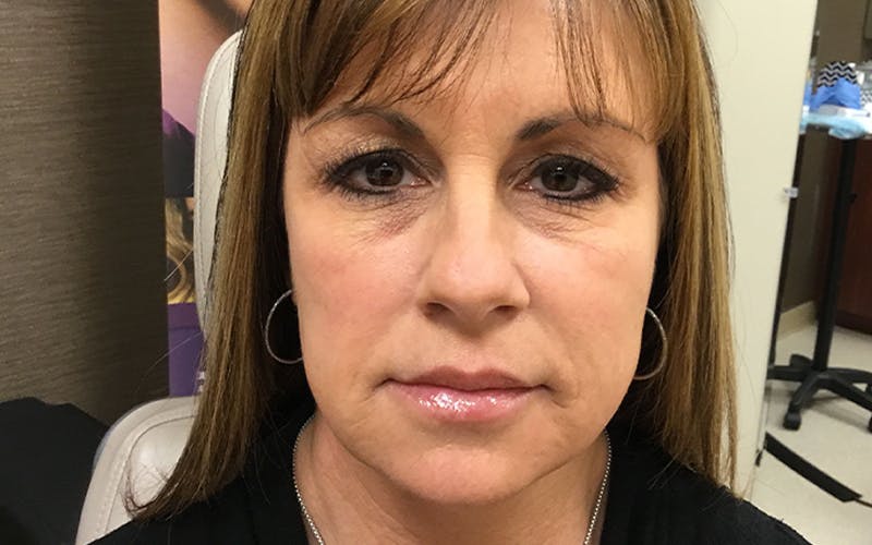 Dermal Fillers & Botox Before & After Gallery - Patient 264376 - Image 1